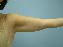 Body Contouring After Major Weight Loss Picture