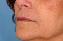 Injectable Fillers Picture
