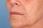 Injectable Fillers Picture