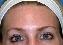 Botulinum Toxin Picture