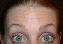 Botulinum Toxin Picture