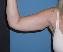 Arm Lift Picture