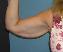Arm Lift Picture