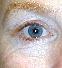 Eyelid Surgery Picture