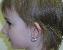 Ear Surgery Picture