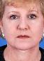 Facelift Picture