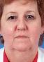 Facelift Picture