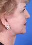 Facelift Picture