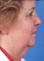 Facelift Picture