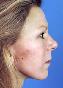 Facelift Picture