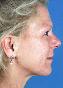 Facelift Picture