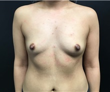 Breast Augmentation Before Photo by Adam Schaffner, MD, FACS; New York, NY - Case 36886