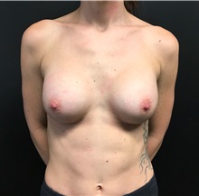 Breast Augmentation After Photo by Adam Schaffner, MD, FACS; New York, NY - Case 36886