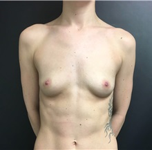 Breast Augmentation Before Photo by Adam Schaffner, MD, FACS; New York, NY - Case 36886