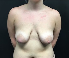 Breast Lift Before Photo by Adam Schaffner, MD, FACS; New York, NY - Case 37524