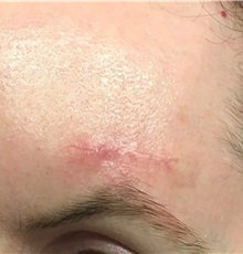 Skin Cancer Removal After Photo by Adam Schaffner, MD, FACS; New York, NY - Case 37525