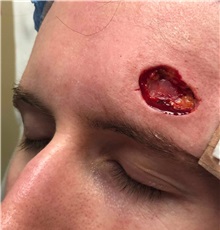 Skin Cancer Removal Before Photo by Adam Schaffner, MD, FACS; New York, NY - Case 37525
