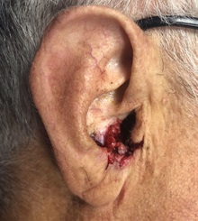 Skin Cancer Removal Before Photo by Adam Schaffner, MD, FACS; New York, NY - Case 37526