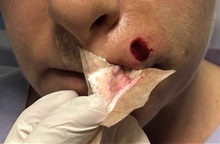 Skin Cancer Removal Before Photo by Adam Schaffner, MD, FACS; New York, NY - Case 37527