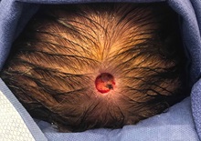 Skin Cancer Removal Before Photo by Adam Schaffner, MD, FACS; New York, NY - Case 37528