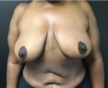 Breast Reduction After Photo by Adam Schaffner, MD, FACS; New York, NY - Case 37530