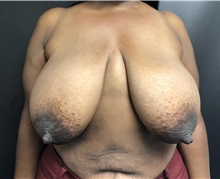 Breast Reduction Before Photo by Adam Schaffner, MD, FACS; New York, NY - Case 37530