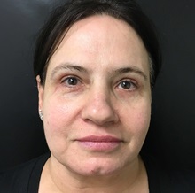 Eyelid Surgery After Photo by Adam Schaffner, MD, FACS; New York, NY - Case 37532