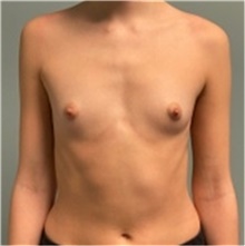 Breast Augmentation Before Photo by Juliane Bodo, MD; Berlin, BE - Case 48240