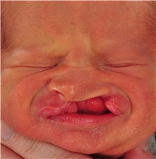 Cleft Lip and Palate Repair Before Photo by Christopher Derderian, MD; Dallas, TX - Case 33727