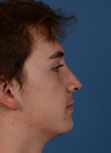 Rhinoplasty After Photo by Christopher Derderian, MD; Dallas, TX - Case 33733