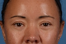 Eyelid Surgery After Photo by Christopher Derderian, MD; Dallas, TX - Case 33734