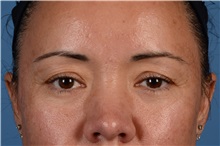 Eyelid Surgery Before Photo by Christopher Derderian, MD; Dallas, TX - Case 33734