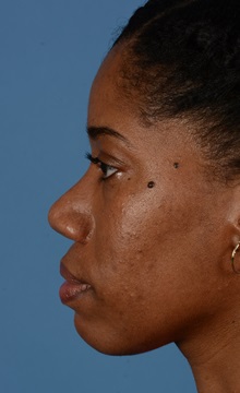 Rhinoplasty After Photo by Christopher Derderian, MD; Dallas, TX - Case 33849