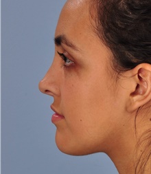 Rhinoplasty After Photo by Christopher Derderian, MD; Dallas, TX - Case 33868