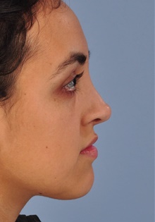 Rhinoplasty After Photo by Christopher Derderian, MD; Dallas, TX - Case 33868
