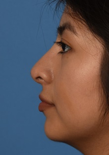 Rhinoplasty After Photo by Christopher Derderian, MD; Dallas, TX - Case 38274