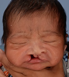Cleft Lip and Palate Repair Before Photo by Christopher Derderian, MD; Dallas, TX - Case 38605