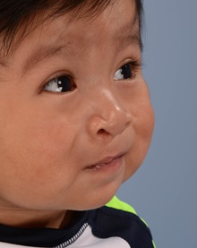 Cleft Lip and Palate Repair After Photo by Christopher Derderian, MD; Dallas, TX - Case 38605