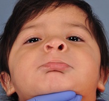 Cleft Lip and Palate Repair After Photo by Christopher Derderian, MD; Dallas, TX - Case 38606