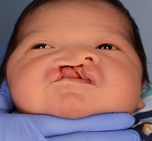 Cleft Lip and Palate Repair Before Photo by Christopher Derderian, MD; Dallas, TX - Case 38606