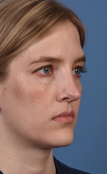 Rhinoplasty After Photo by Christopher Derderian, MD; Dallas, TX - Case 47658