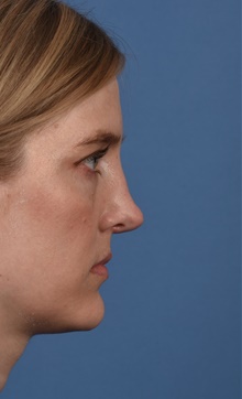 Rhinoplasty After Photo by Christopher Derderian, MD; Dallas, TX - Case 47658