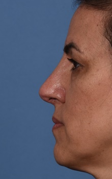 Rhinoplasty After Photo by Christopher Derderian, MD; Dallas, TX - Case 47661