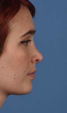 Rhinoplasty After Photo by Christopher Derderian, MD; Dallas, TX - Case 47663
