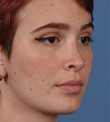 Rhinoplasty After Photo by Christopher Derderian, MD; Dallas, TX - Case 47663