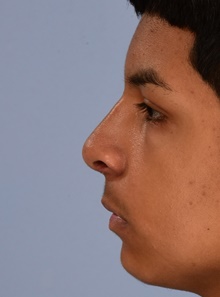 Rhinoplasty After Photo by Christopher Derderian, MD; Dallas, TX - Case 47664