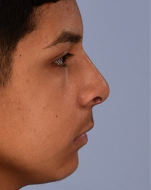 Rhinoplasty After Photo by Christopher Derderian, MD; Dallas, TX - Case 47664