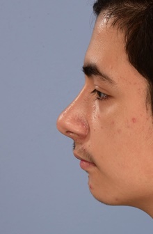 Rhinoplasty After Photo by Christopher Derderian, MD; Dallas, TX - Case 47665