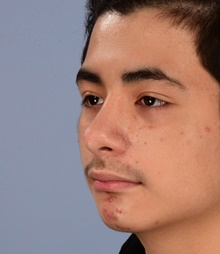 Rhinoplasty After Photo by Christopher Derderian, MD; Dallas, TX - Case 47665