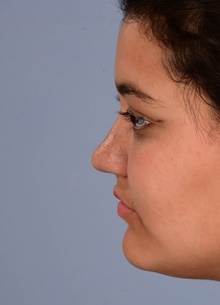 Rhinoplasty After Photo by Christopher Derderian, MD; Dallas, TX - Case 47666